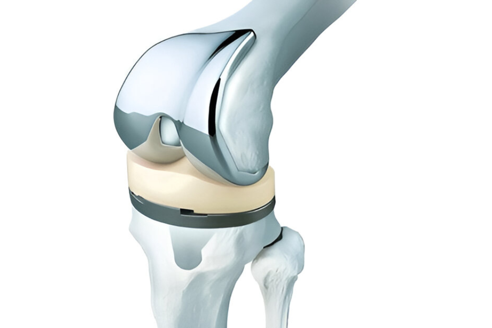 Artroplastia
